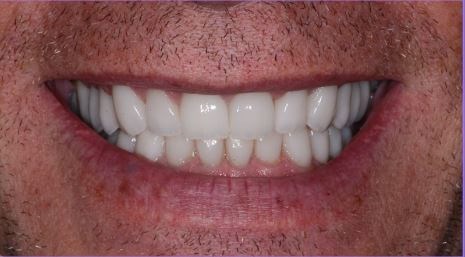 Full Mouth Reconstruction After