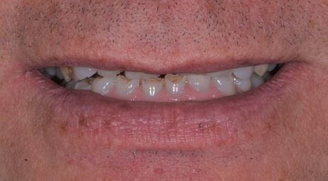 Full Mouth Reconstruction Before