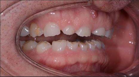 Full Mouth Reconstruction Before