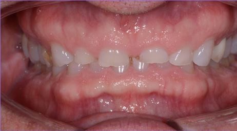Full Mouth Reconstruction Before