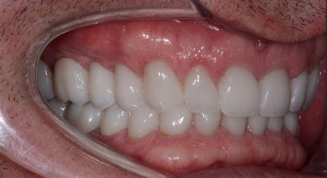 Full Mouth Reconstruction After