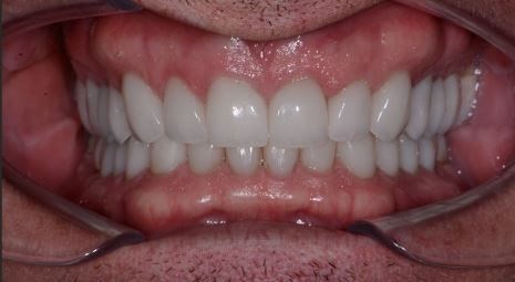 Full Mouth Reconstruction After