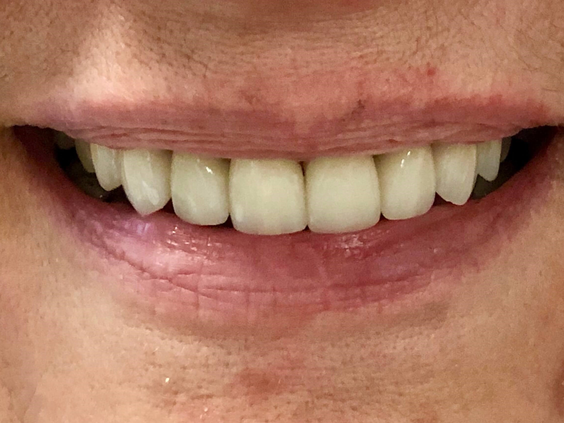 Porcelain Crowns After
