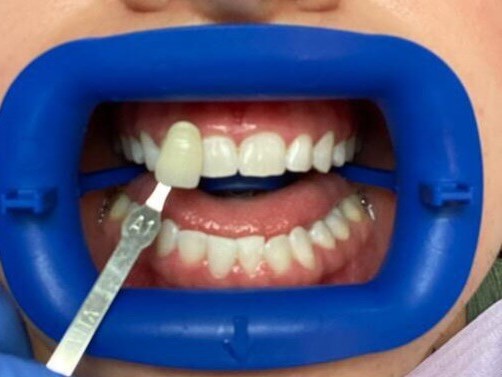 Zoom! Whitening After