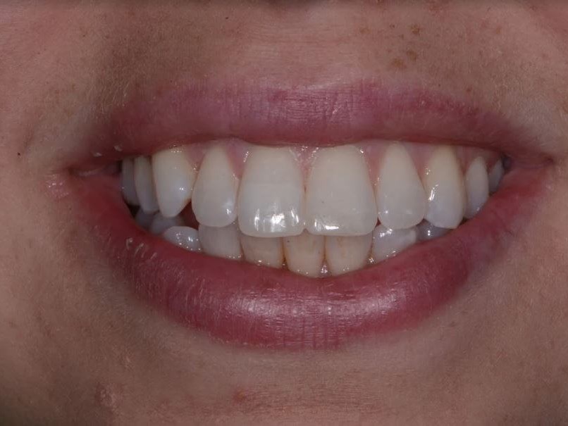 Composite Bonding After