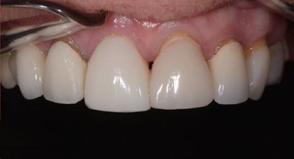 Porcelain Crowns Before
