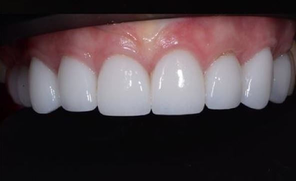 Porcelain Crowns After