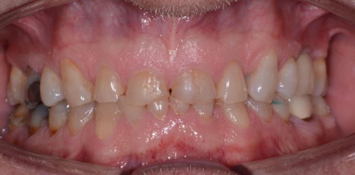 Full Mouth Rehabilitation Before