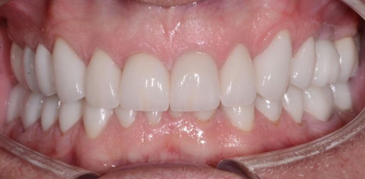 Full Mouth Rehabilitation After