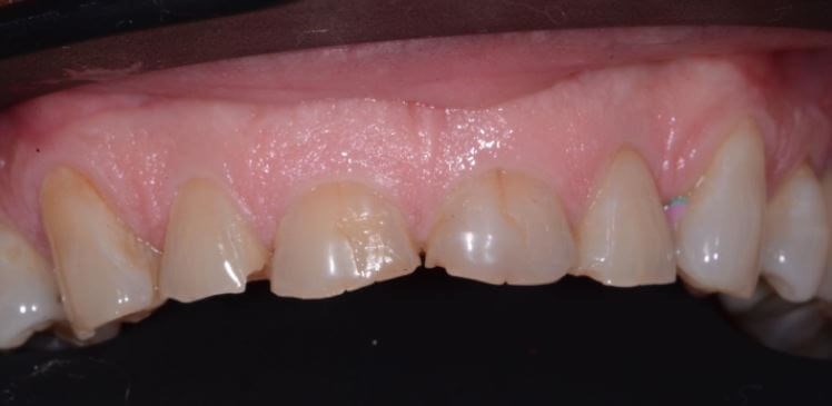 Full Mouth Rehabilitation Before