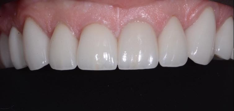 Full Mouth Rehabilitation After