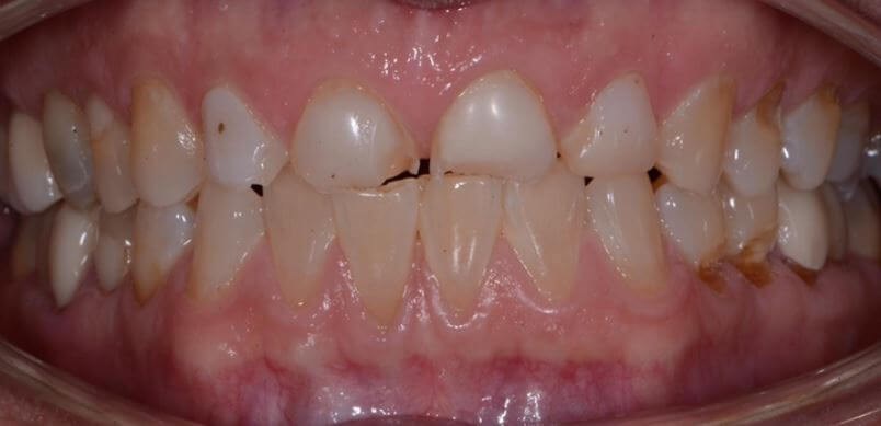 Porcelain Crowns Before