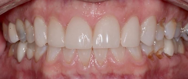 Porcelain Crowns After