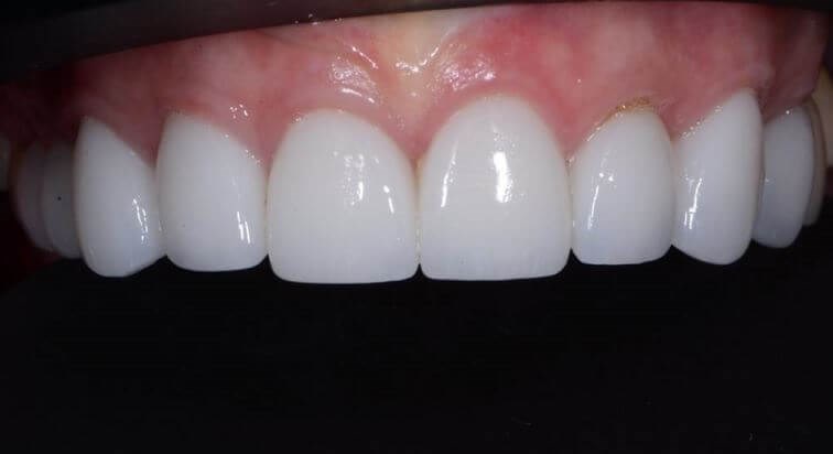 Replacement Porcelain Crowns After