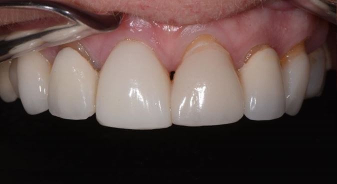 Replacement Porcelain Crowns Before