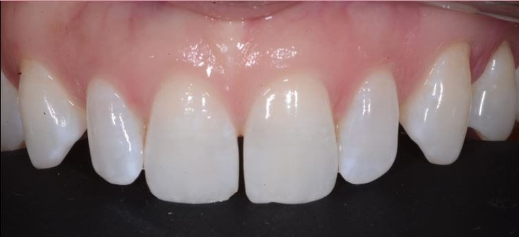 Close Diastema Before