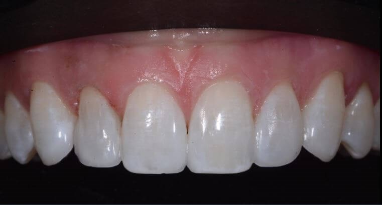 Close Diastema After