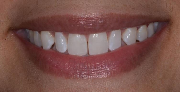 Close Diastema Before