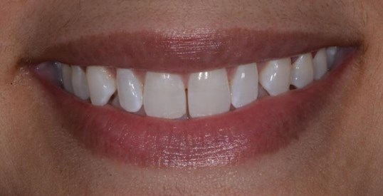 Close Diastema Before