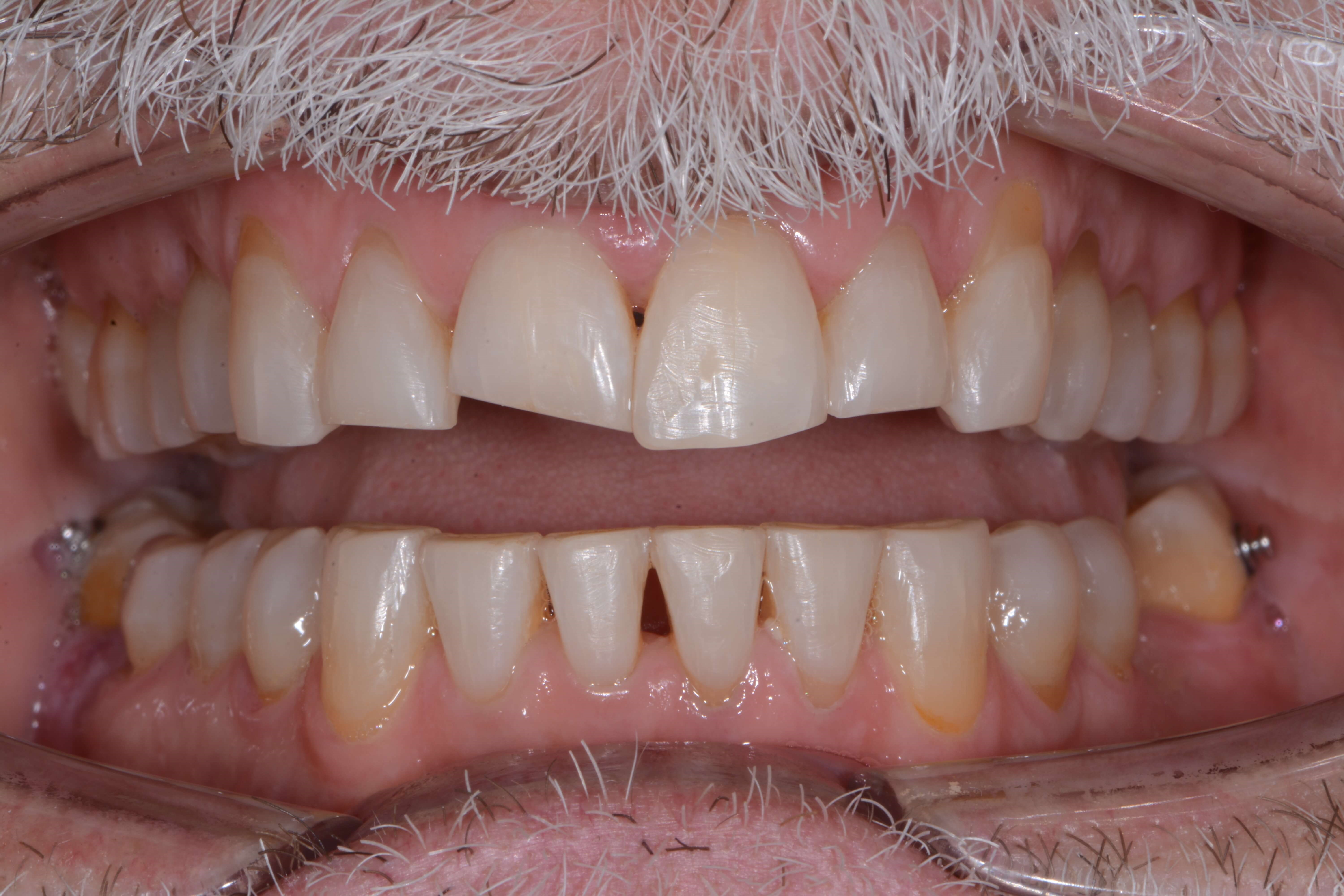 Full mouth Before