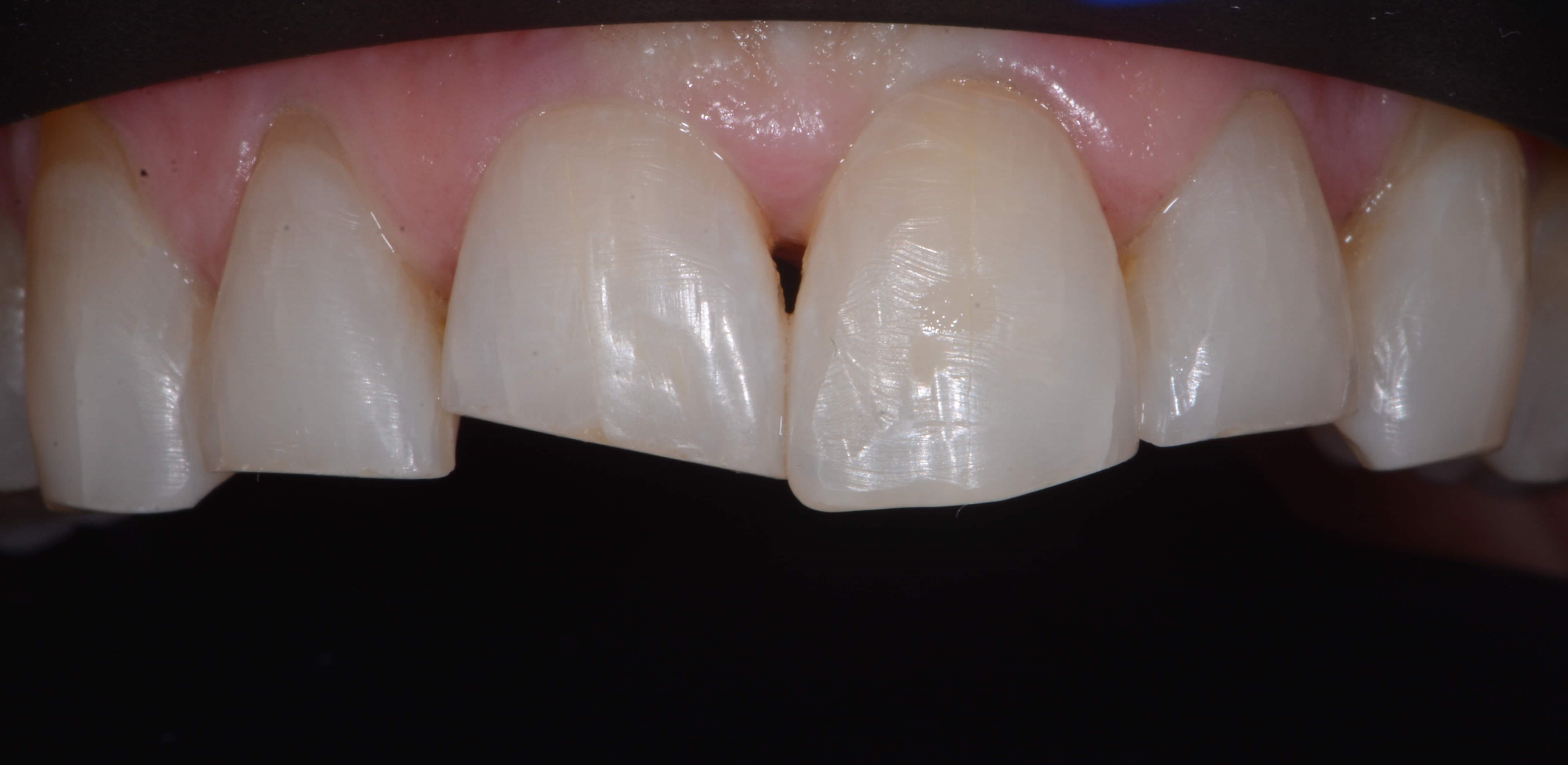 Anteriors Before