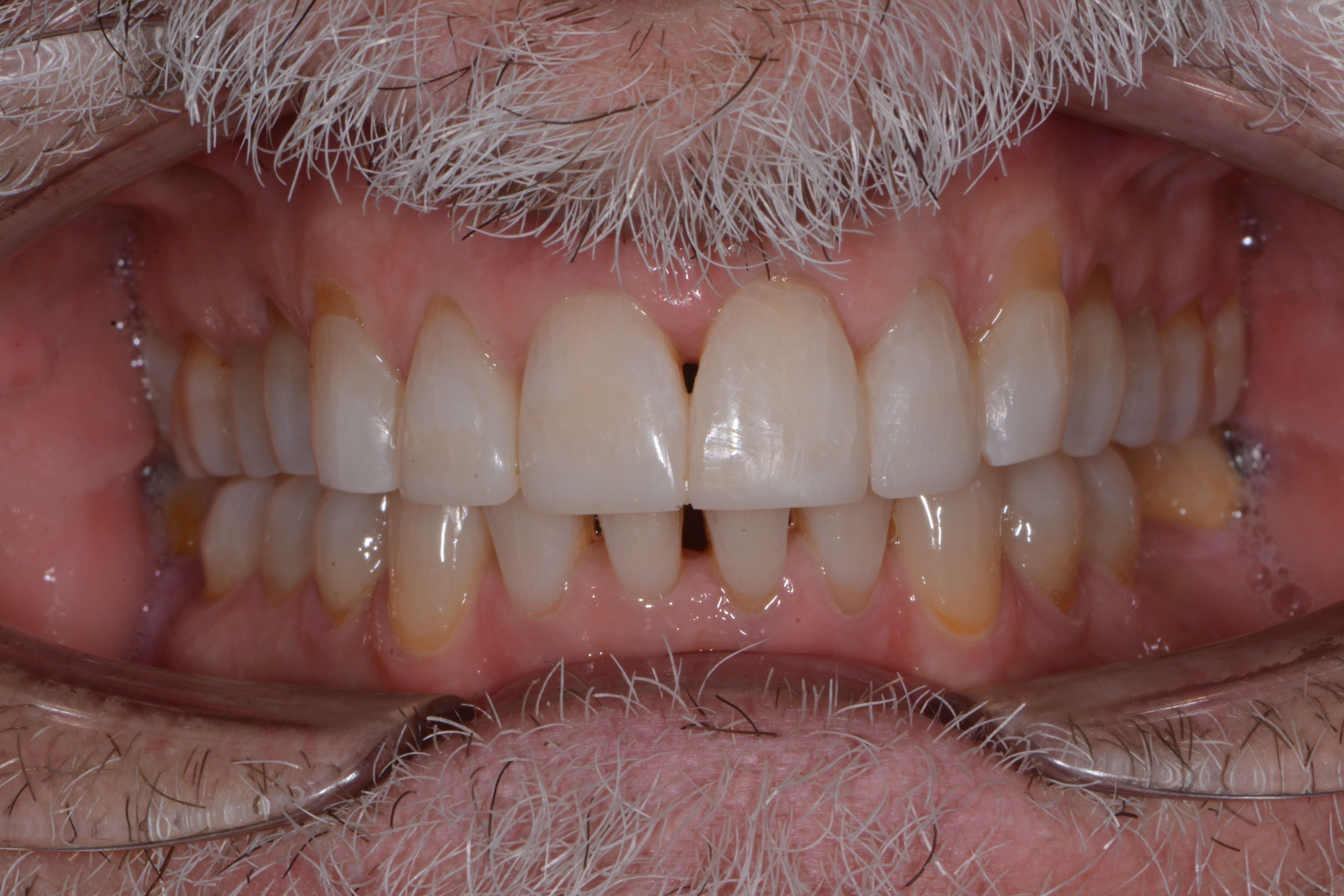 Full mouth After