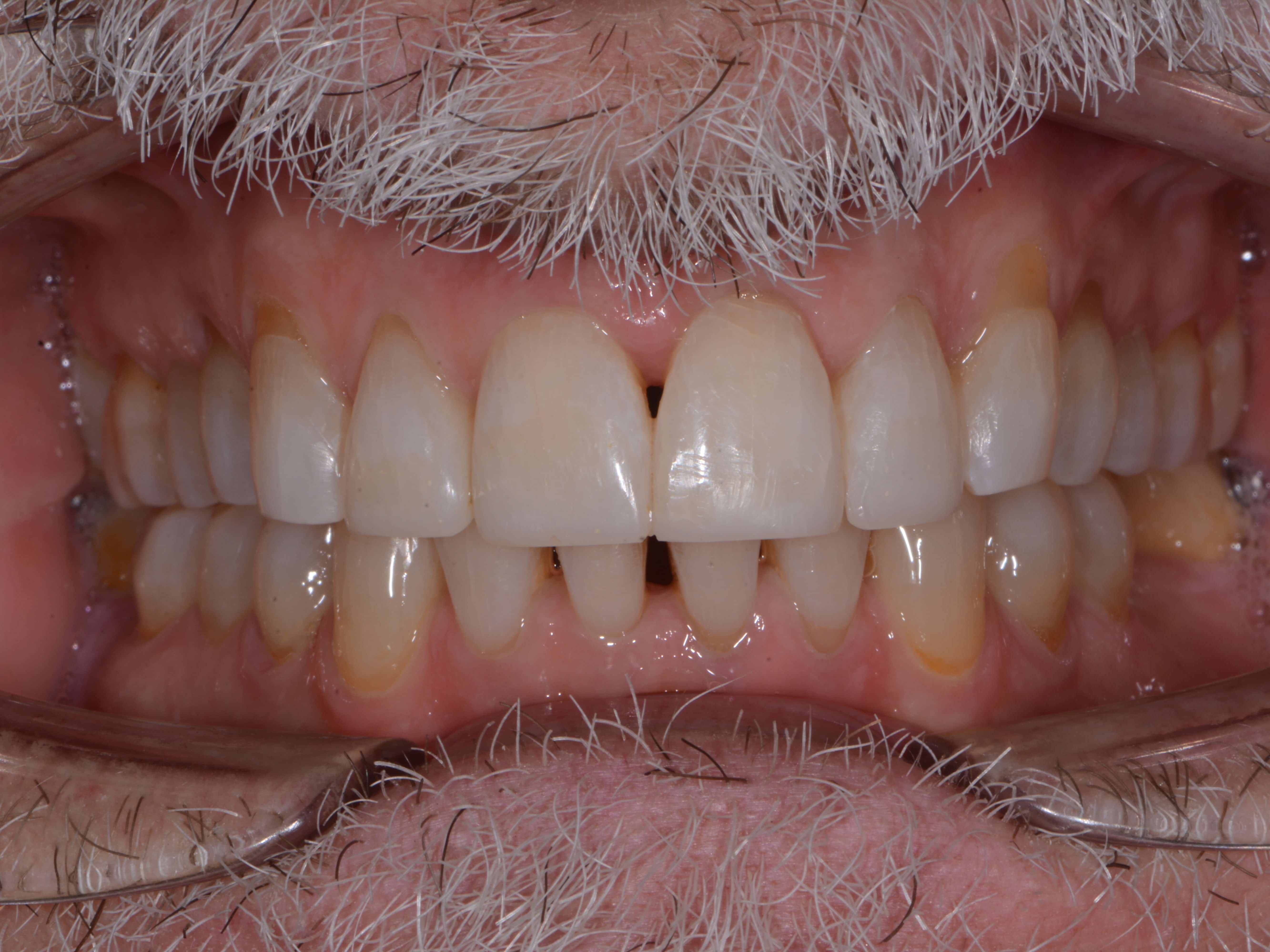 Full mouth After