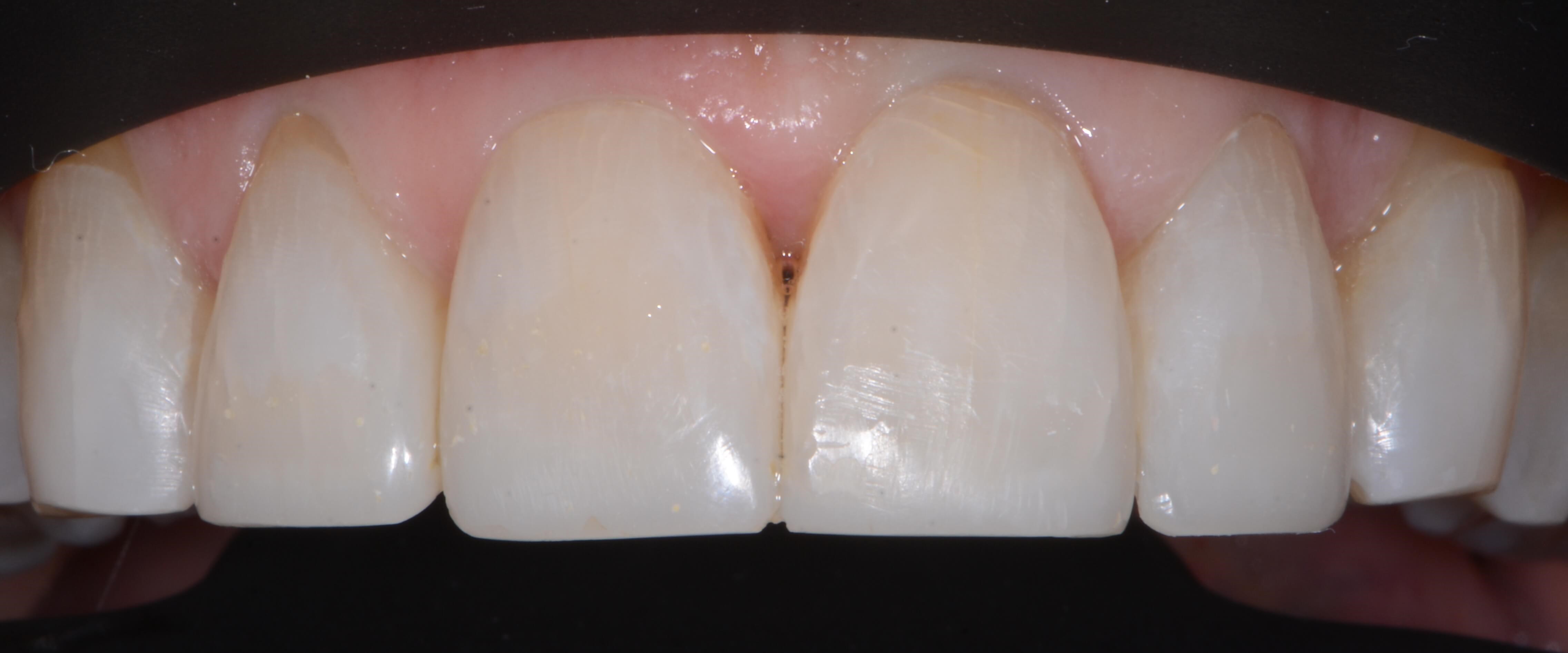 Anteriors After