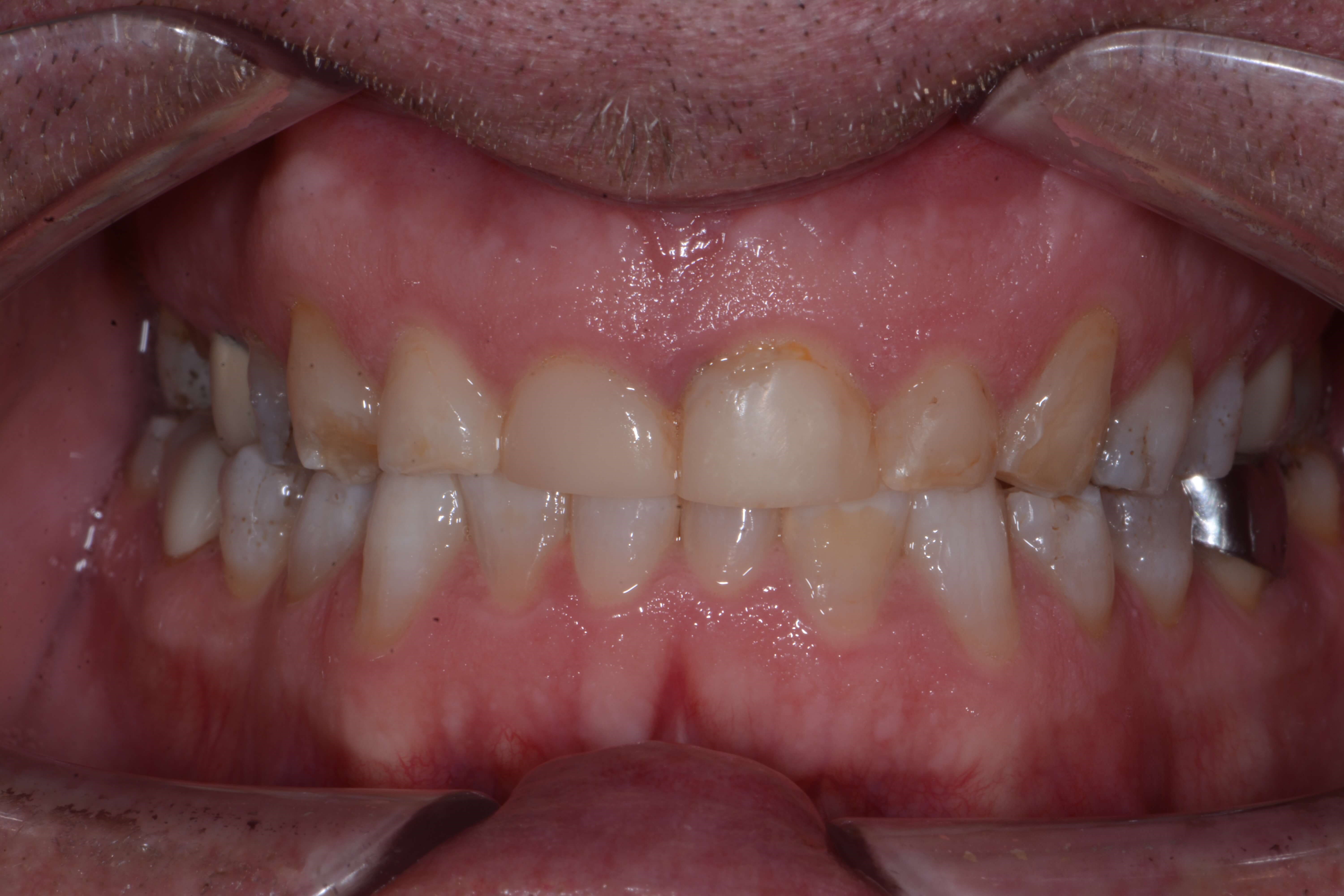Full Mouth Rehabilitation Before