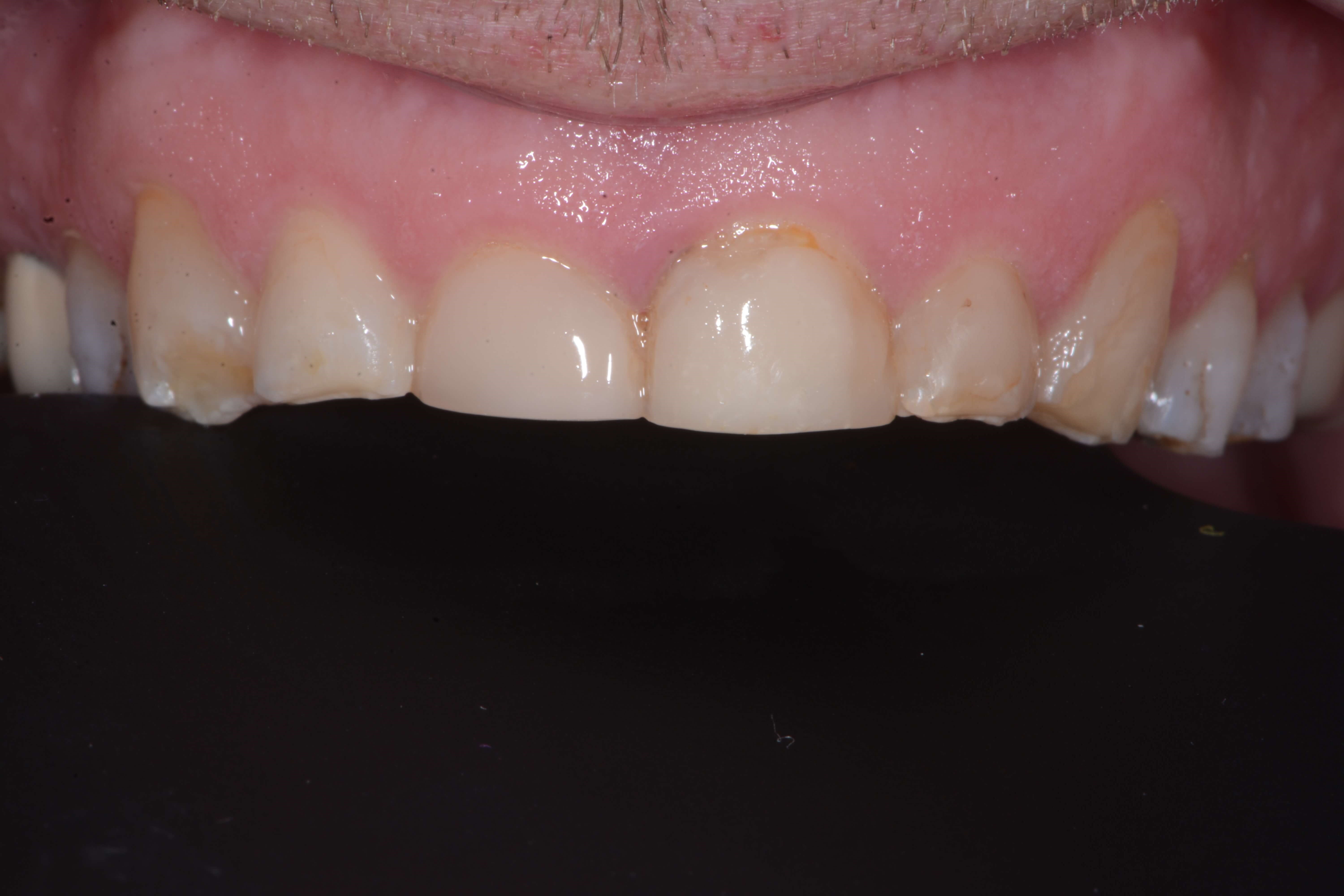 Anteriors Before
