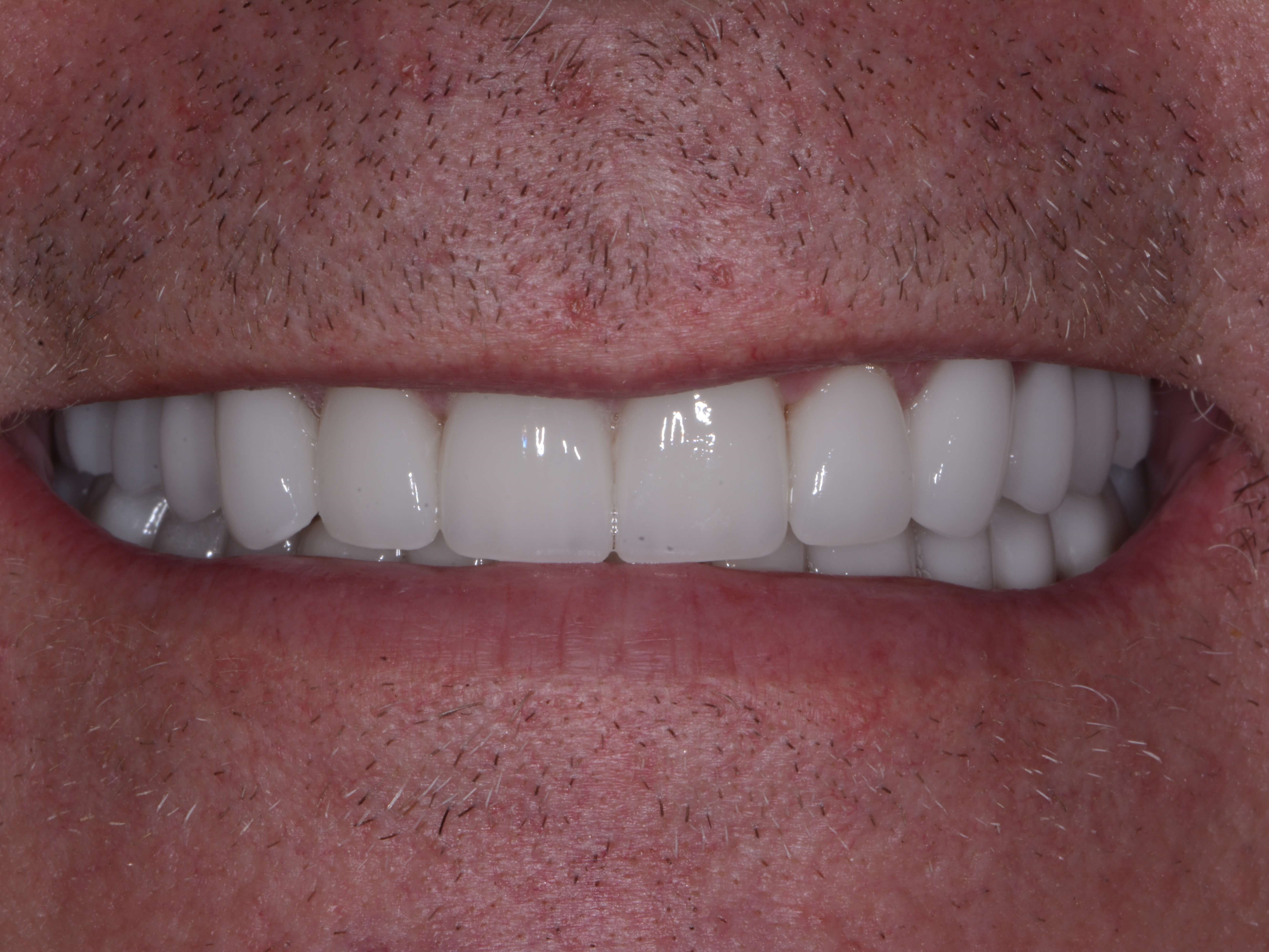 Full Mouth Rehabilitation After