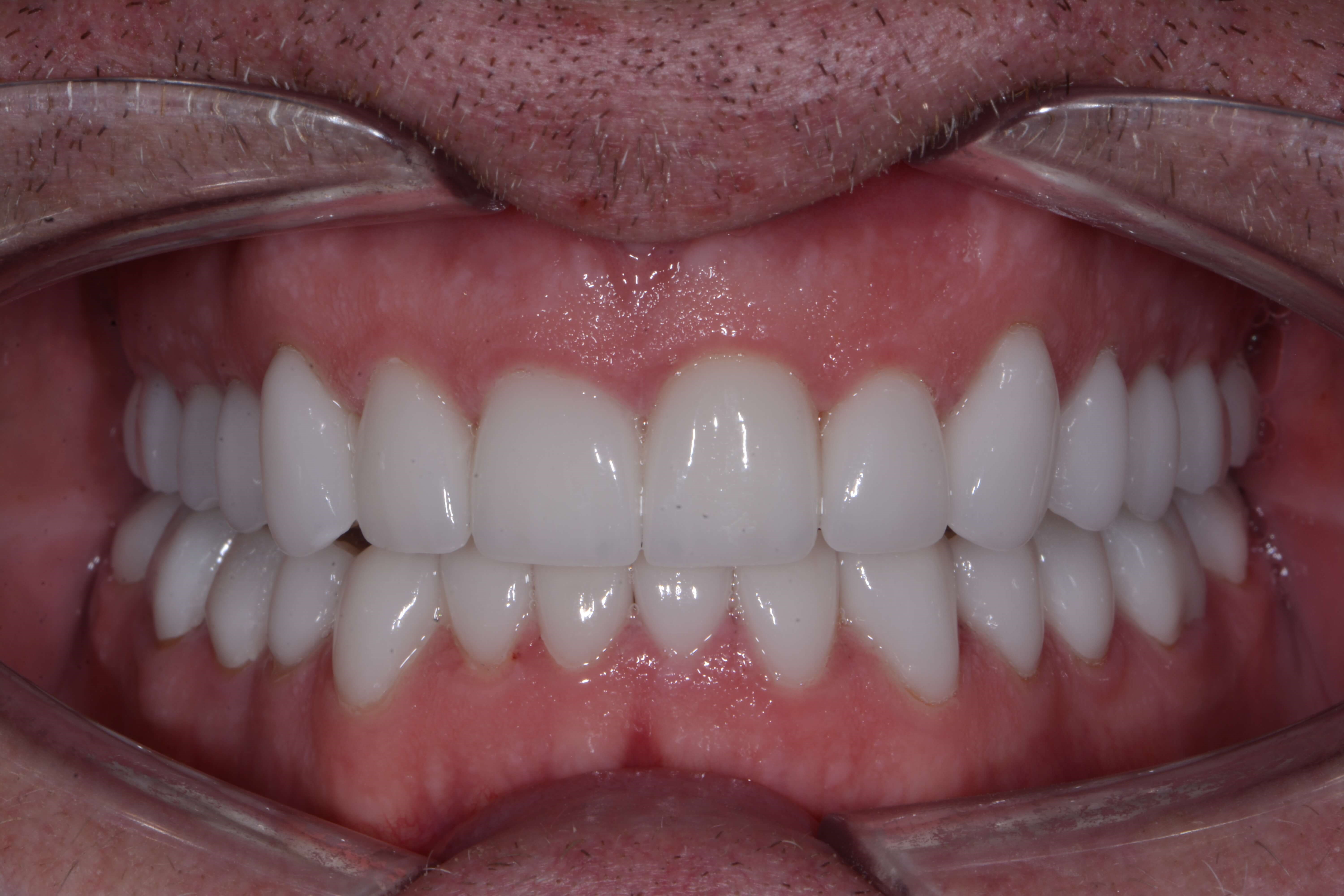 Full Mouth Rehabilitation After