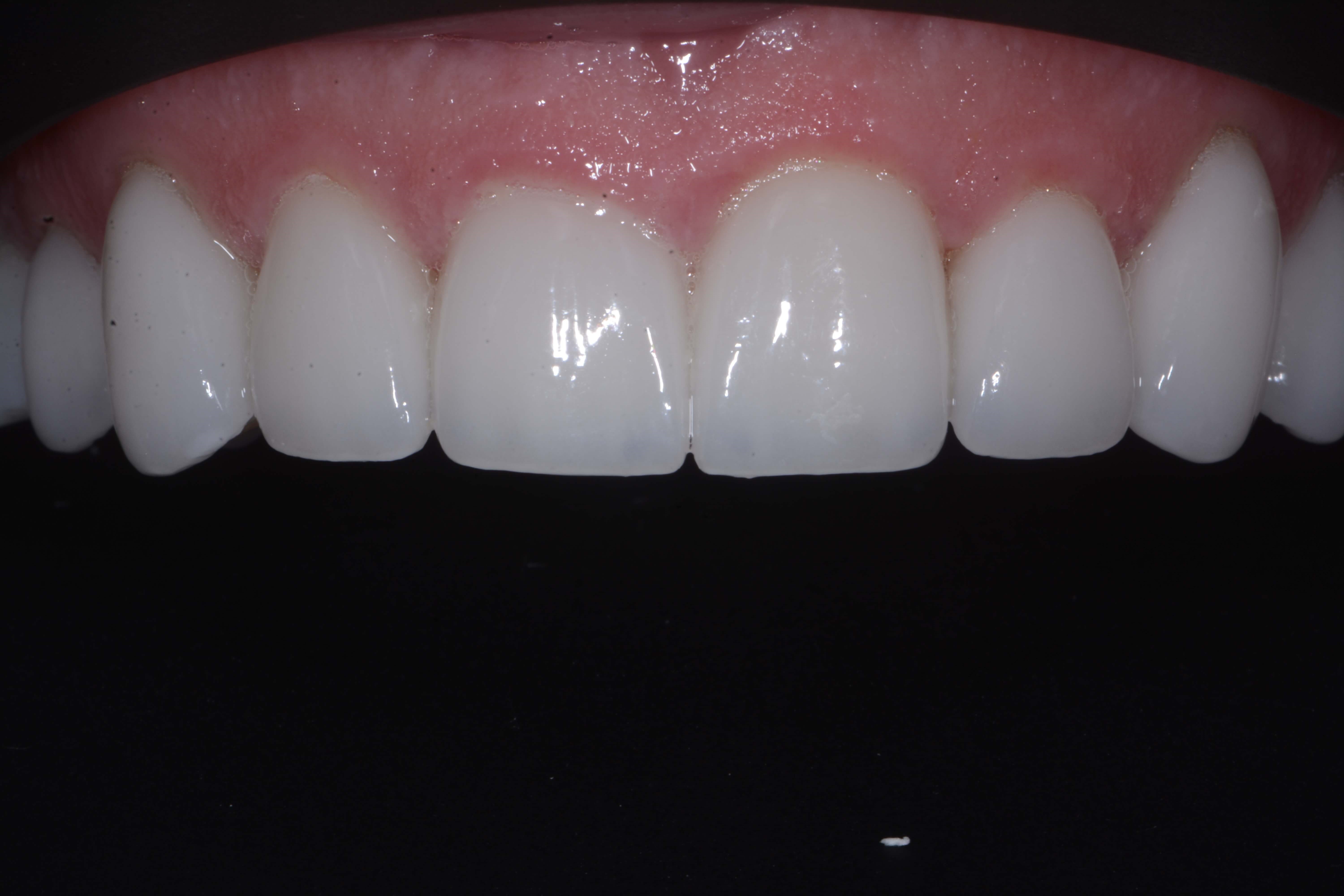 Anteriors After