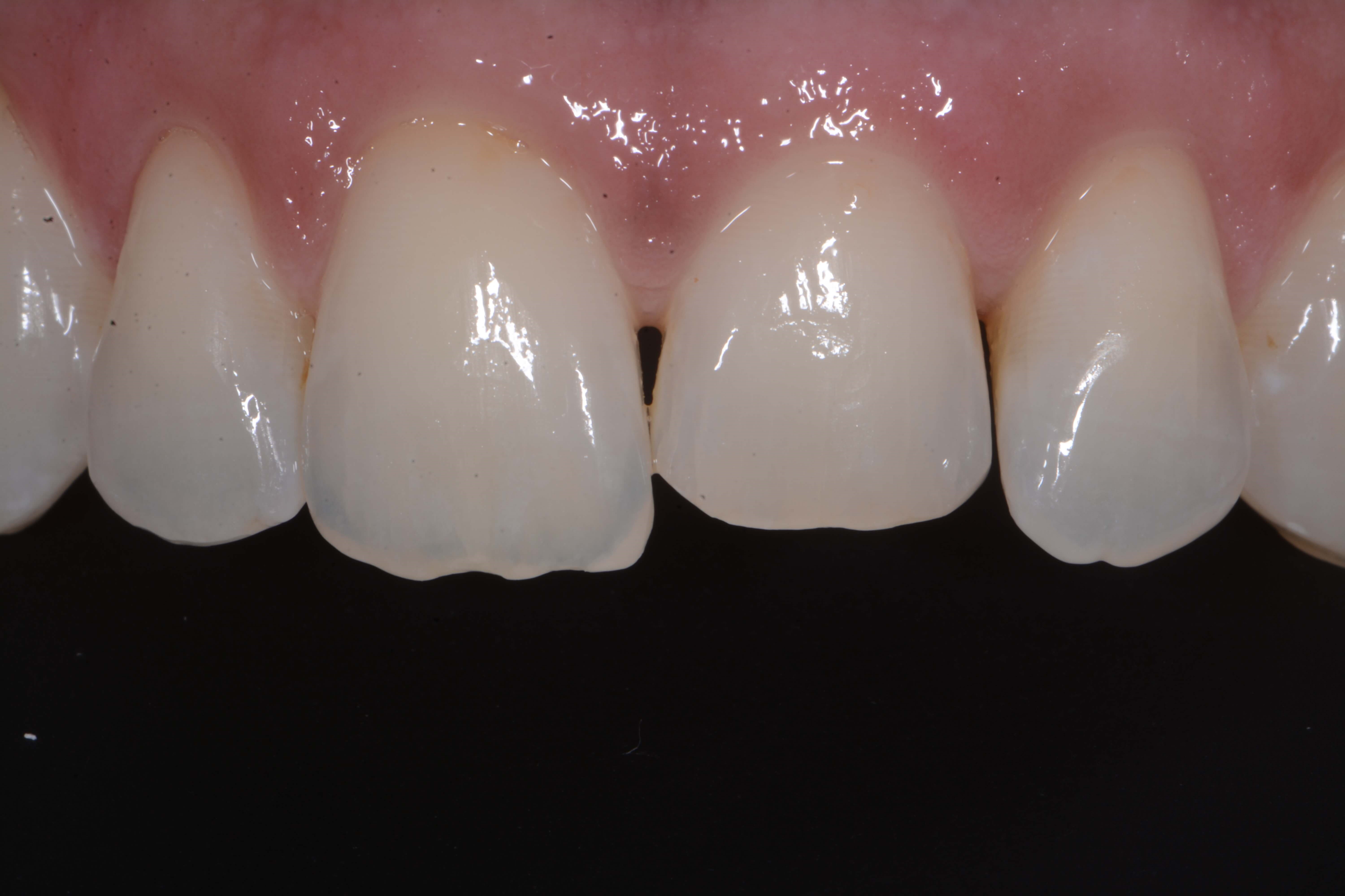 Composite Bonding Before
