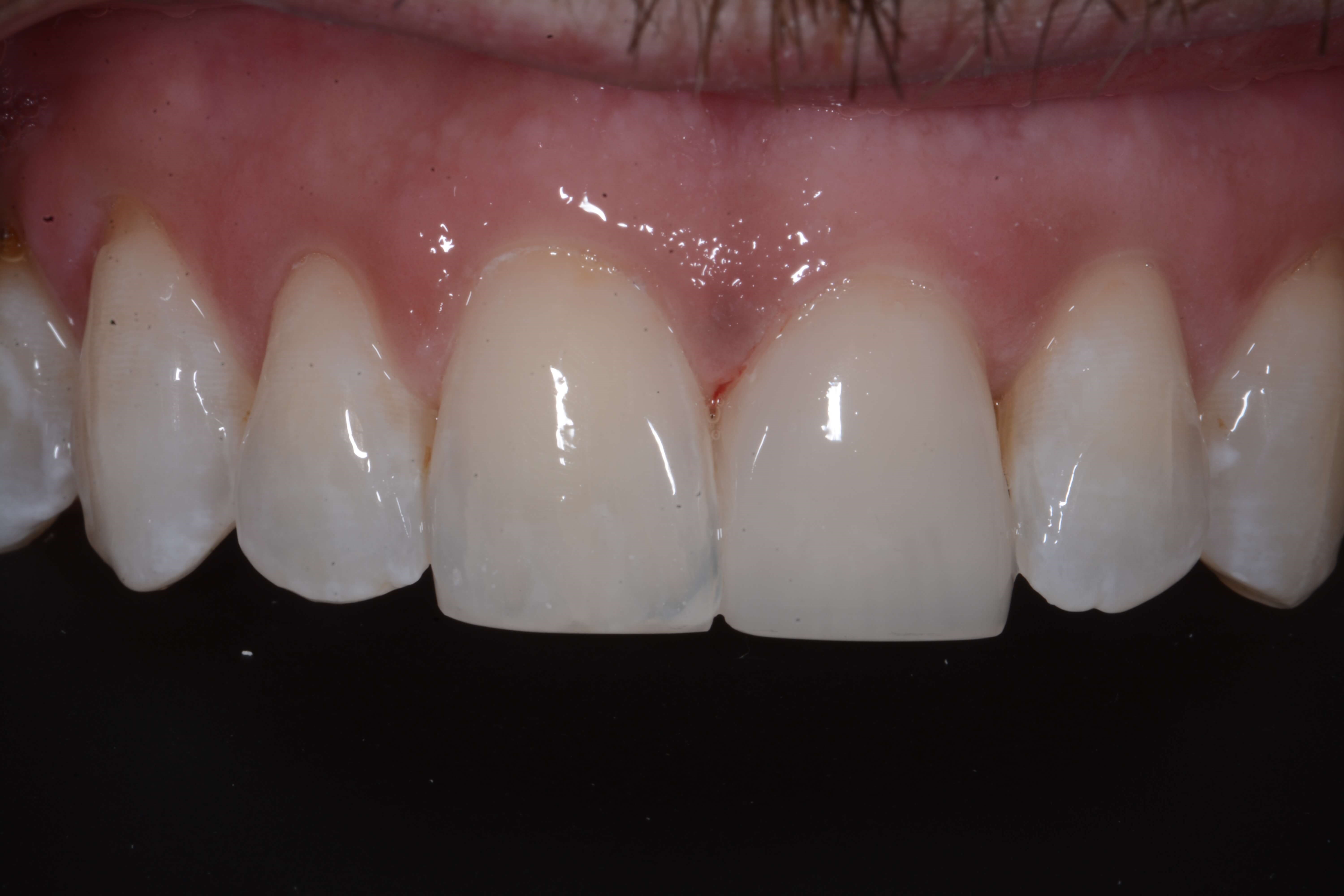 Composite Bonding After