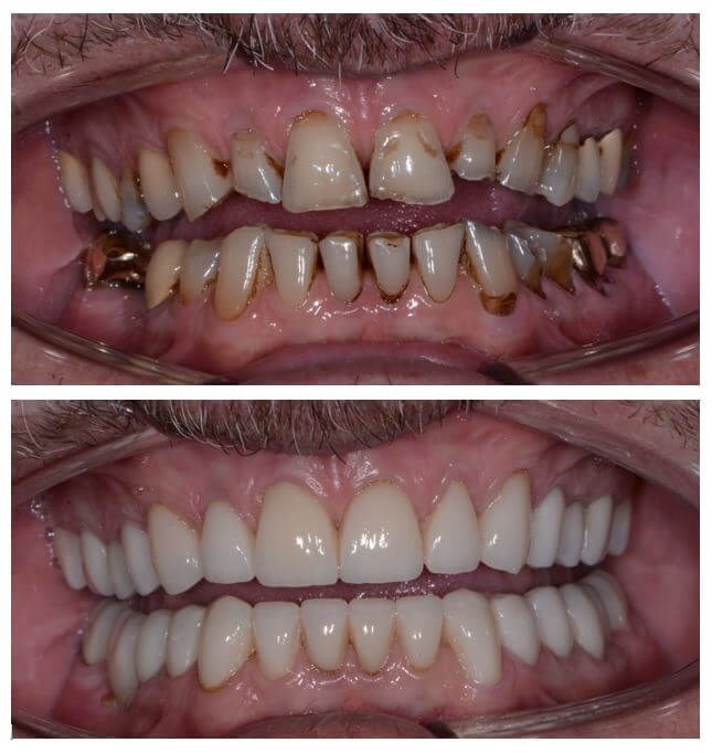 Dental Before and After Photo